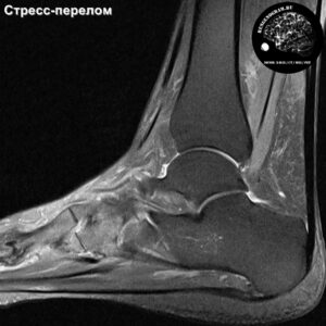 МРТ/рентген голени со стресс‑повреждением.