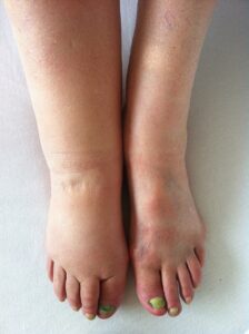https://en.wikipedia.org/wiki/Lymphedema?utm_medium=organic&utm_source=yandexsmartcamera